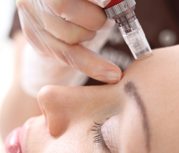 Microneedling