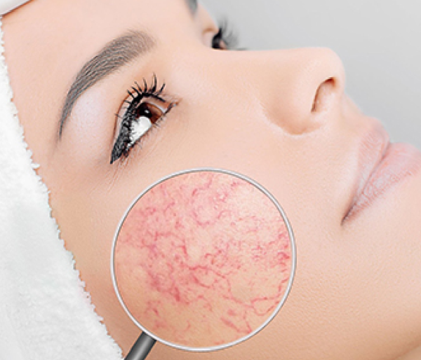Broken Capillaries