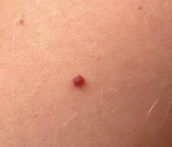 Cherry Angiomas