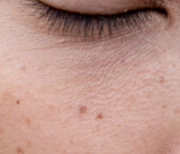 Flat Hyperpigmentation