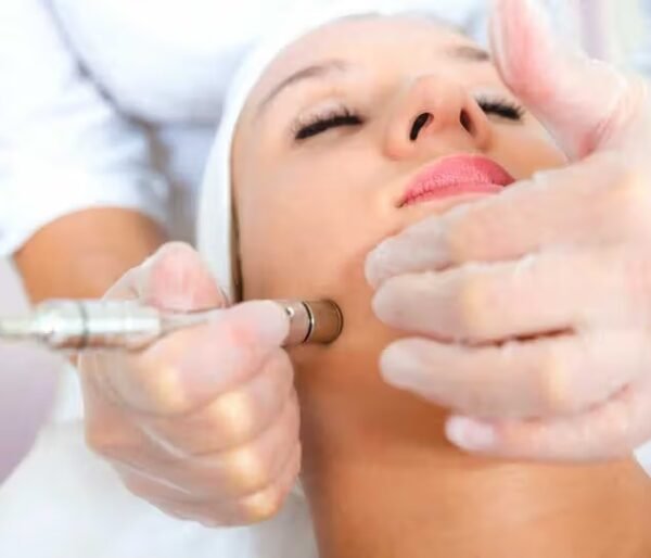 Microdermabrasion